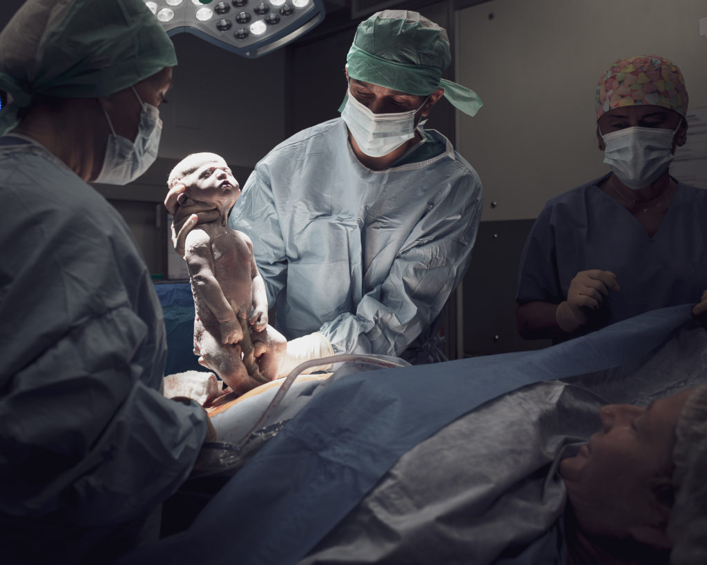 Nouveau né jaillissant du ventre de sa mère- naissance par césarienne