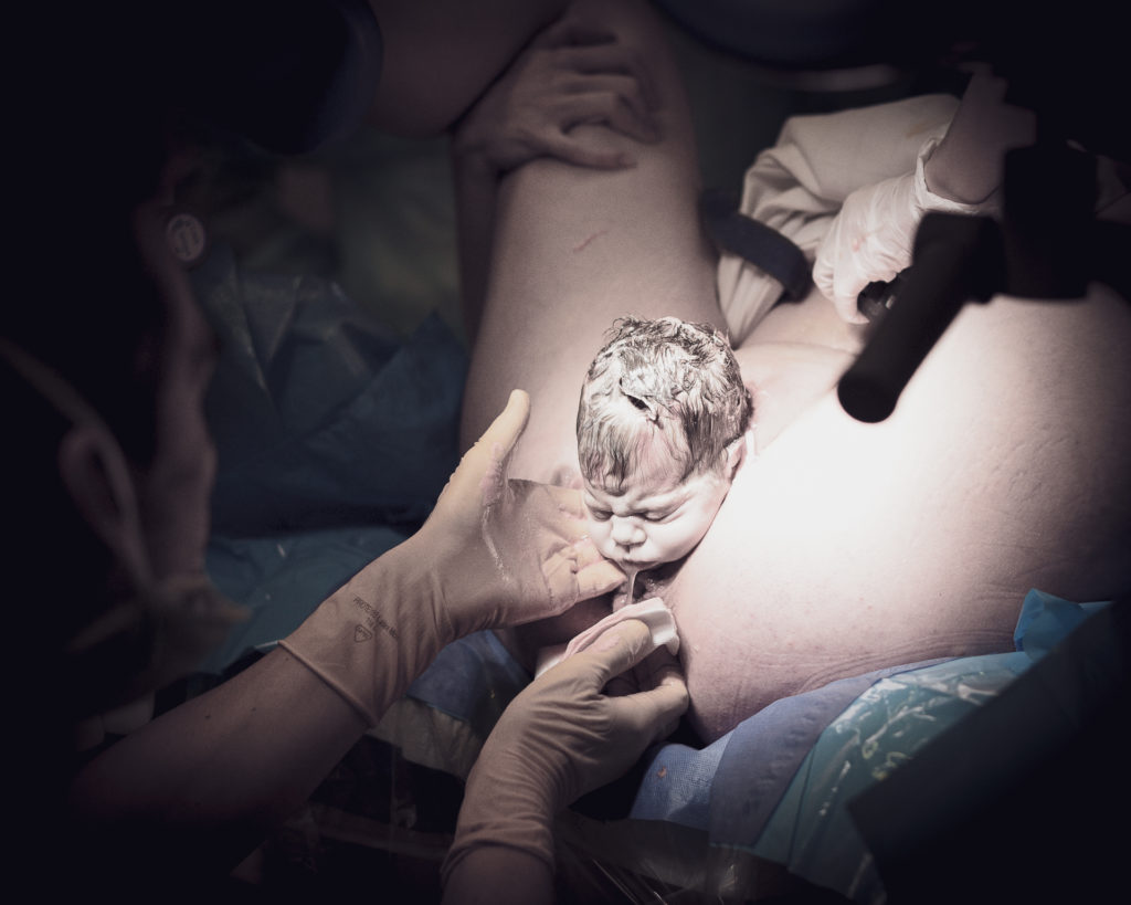 Tete du foetus sortant juste de l'uterus- naissance